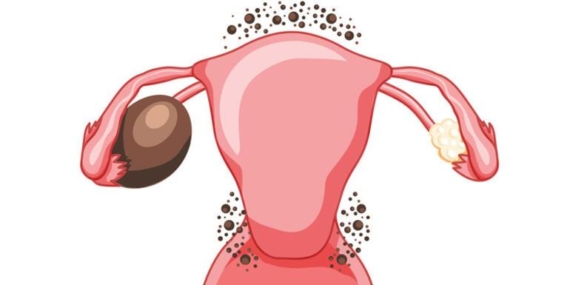 10 SORUDA ENDOMETRİOZİS DOSYASI | Dünyada ilk kez bilinen her endometriozis türünden doku üretildi!